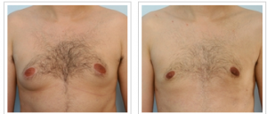 Male Breast Reduction in Houston, TX