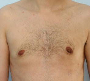  Gynecomastia Photo - Patient 1 - After 1