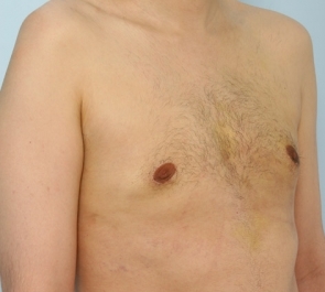  Gynecomastia Photo - Patient 1 - After 2