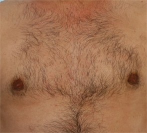  Gynecomastia Photo - Patient 2 - After 1