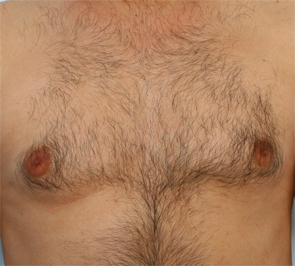  Gynecomastia Photo - Patient 2 - Before 1