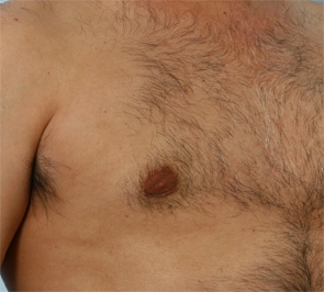  Gynecomastia Photo - Patient 2 - After 2