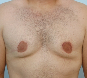  Gynecomastia Photo - Patient 3 - After 1