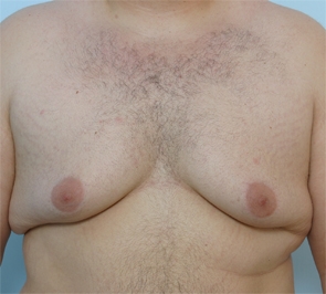  Gynecomastia Photo - Patient 3 - Before 1