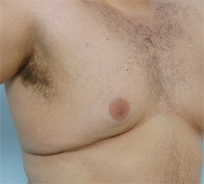  Gynecomastia Photo - Patient 3 - Before 2