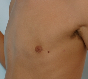  Gynecomastia Photo - Patient 4 - After 2