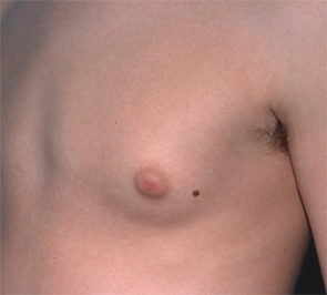  Gynecomastia Photo - Patient 4 - Before 2