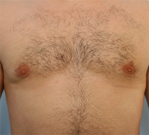  Gynecomastia Photo - Patient 5 - After 1