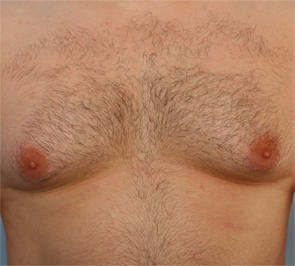  Gynecomastia Photo - Patient 5 - Before 1