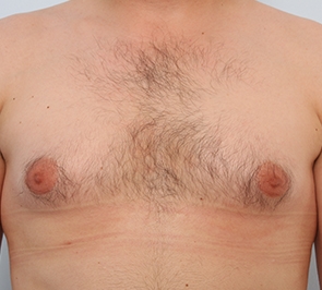  Gynecomastia Photo - Patient 10 - Before 1