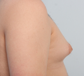  Gynecomastia Photo - Patient 11 - Before 2