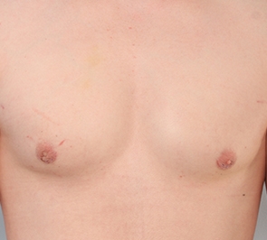  Gynecomastia Photo - Patient 18 - After 1