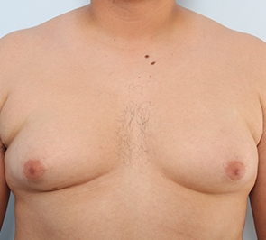  Gynecomastia Photo - Patient 22 - Before 1