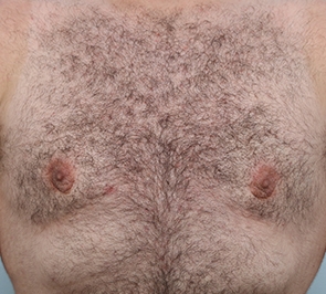  Gynecomastia Photo - Patient 24 - After 1